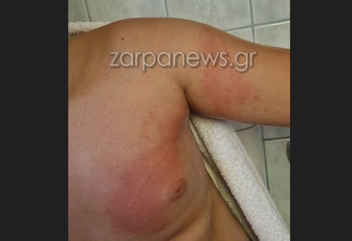 Τσίμπημα από θαλάσσια ανεμώνη σε 11χρονο