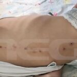 Τα σημάδια στο κορμάκι του 10χρονου στην Πάτρα
