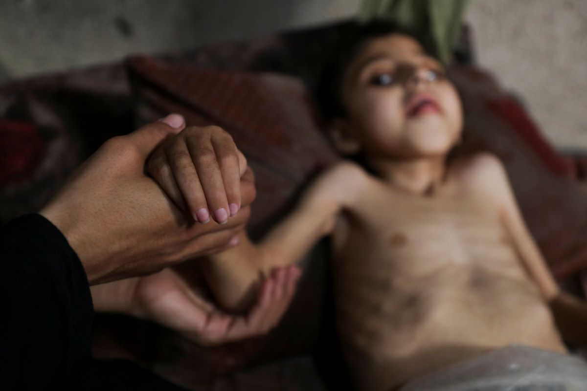 Palestinian, Samah Matar holds her malnourished son Youssef, who suffers from cerebral palsy