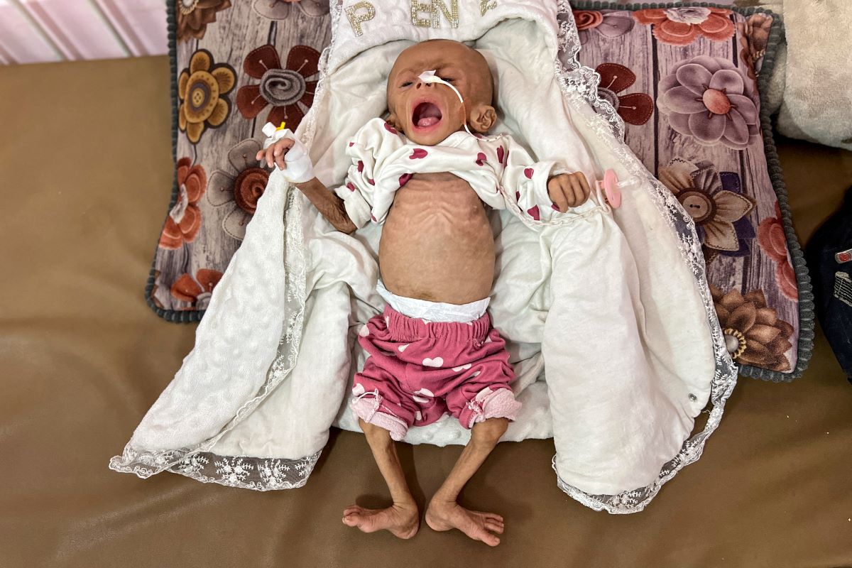 Zainab Abu Halib, a five -month Palestine little girl diagnosed with malnutrition