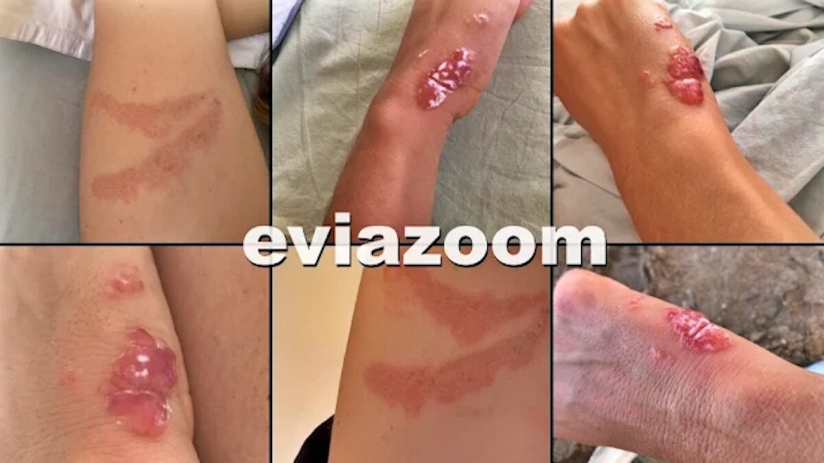 Τσιμπήματα από Μωβ μέδουσες και τσούχτρες στην Εύβοια
