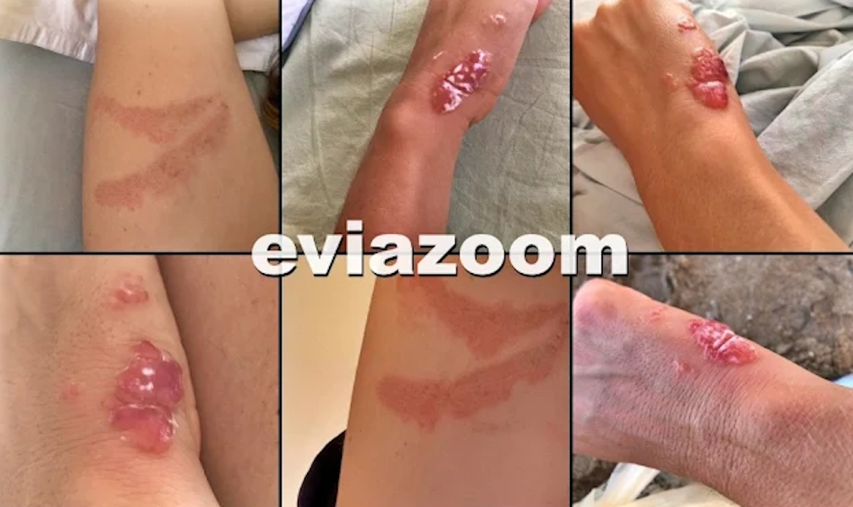 Τσιμπήματα από Μωβ μέδουσες και τσούχτρες στην Εύβοια