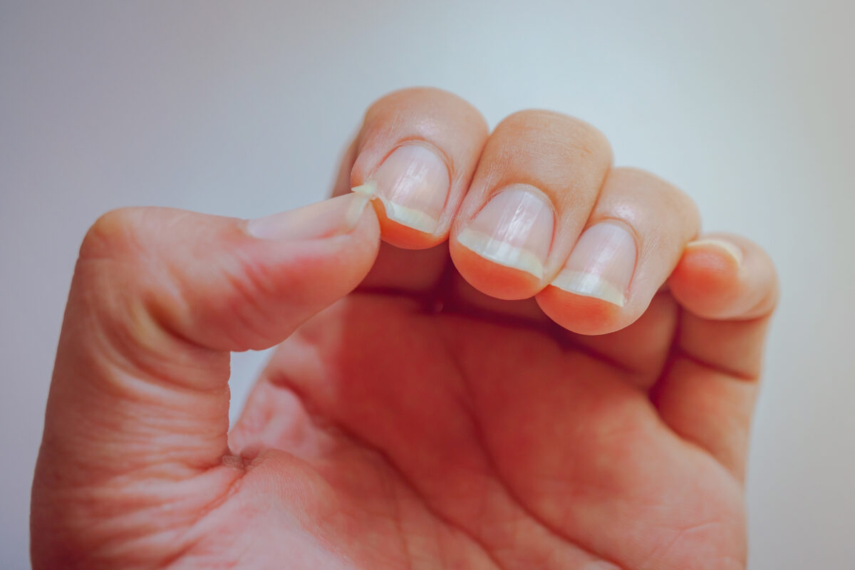 The nail at the index finger tear. Cause pain at the fingertips.