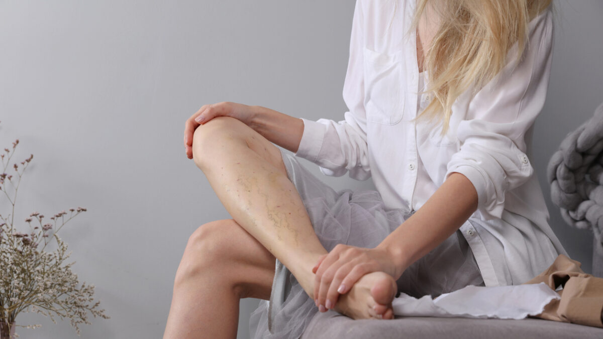 Varicose vein laser surgery recovery and prevention, Compression Stockings Thigh