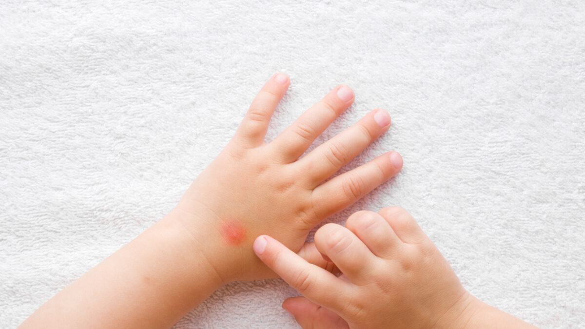 Baby girl finger pointing to itchy hand skin after mosquito bites on white towel background