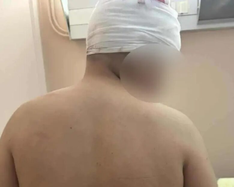 Θεσσαλονίκη: Για απόπειρα ανθρωποκτονίας διώκεται ο 18χρονος που ξυλοκόπησε άγρια 13χρονο στις Συκιές