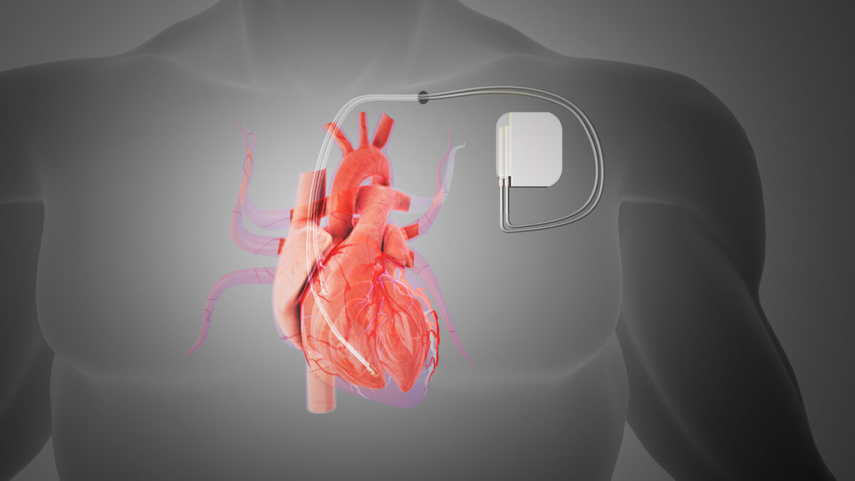 The pacemaker is connected to the heart via tiny wires (leads) that extend from the device and are gently attached to specific parts of the heart muscle. Theleadsare represented as thin, flexible lines, indicating their delicate nature.Around the heart and pacemaker, there are soft, glowing lines or shimmering lights to symbolize the flow of life-giving energy that the pacemaker provides to the heart. This representation can evoke a sense of hope and vitality, showcasing how the pacemaker helps regulate and stabilize the heart's rhythm, improving the person's overall quality of life.