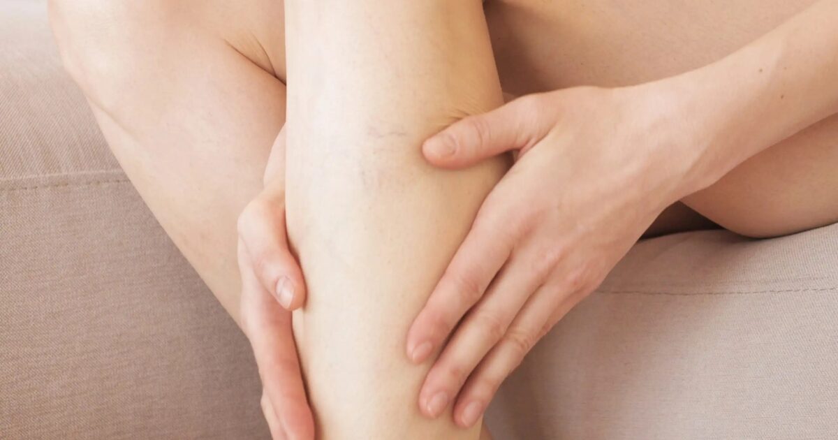 Chronic Venous Disease: The silent disease appearing “quietly” – 7 out of 10 Greeks were first examined