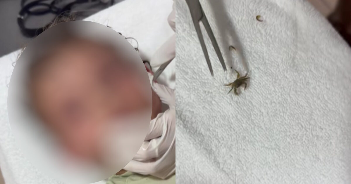 Crab entered a boy’s ear in Mexico: Watch video as long as doctors make it alive