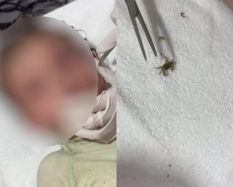 Καβούρι μπήκε στο αυτί ενός αγοριού στο Μεξικό: Δείτε βίντεο από τη στιγμή που οι γιατροί το βγάζουν ζωντανό