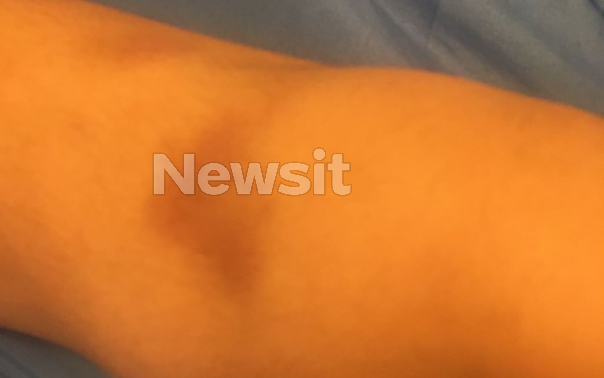 Σημάδια στα χέρια του 13χρονου που ξυλοκοπήθηκε από 15 άτομα στο Μοσχάτο