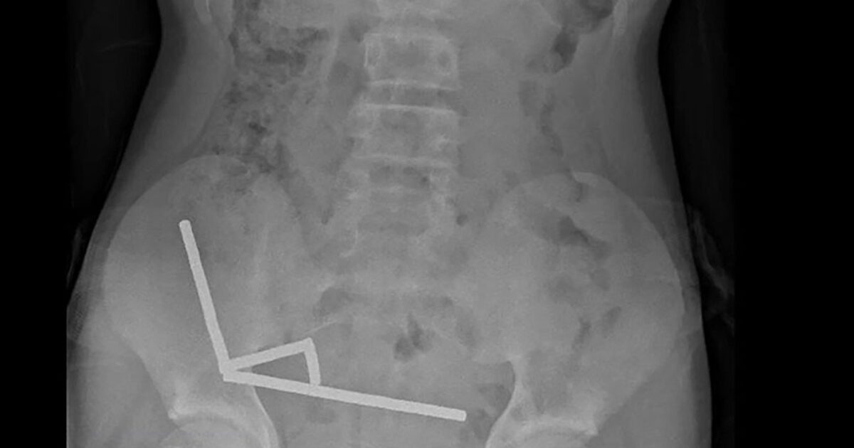 New Zealand: Doctors remove dozens of magnets from 13-year-old’s intestine New Zealand: Doctors remove dozens of magnets from 13-year-old’s intestine