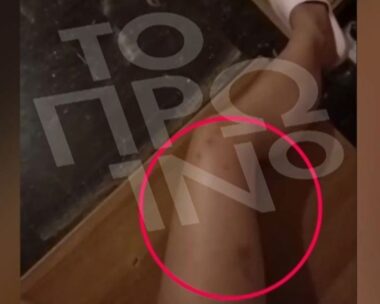 Άγριος ξυλοδαρμός 19χρονης από τον πρώην σύντροφό της