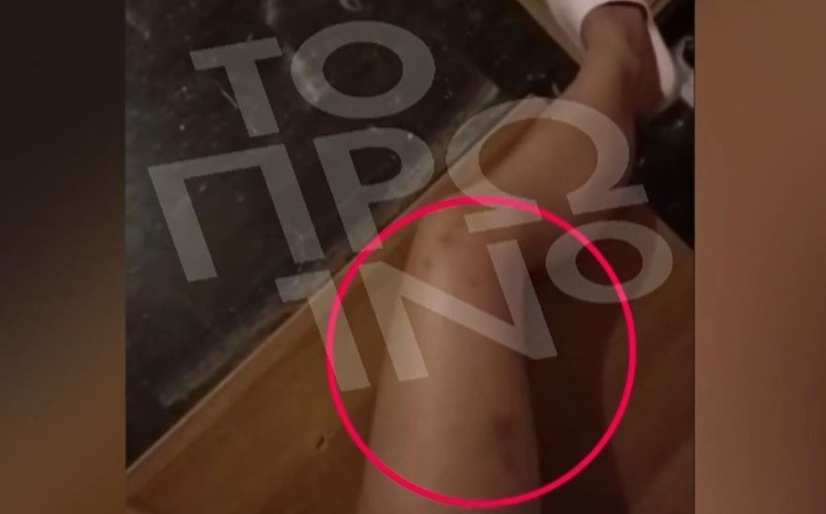 Άγριος ξυλοδαρμός 19χρονης από τον πρώην σύντροφό της