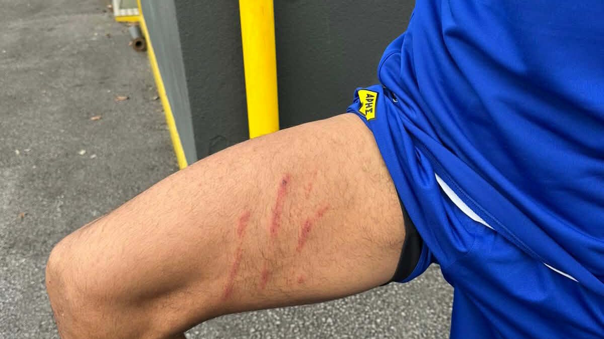 Άρης: Τα σημάδια που άφησε στο πόδι του Ρόουζ το μαρκάρισμα του Ιβανούσετς