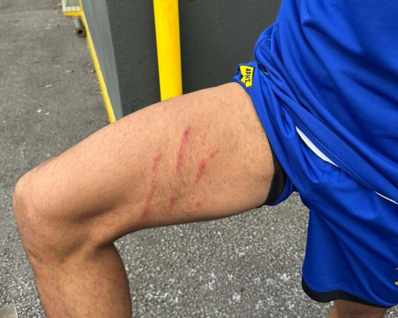 Άρης: Τα σημάδια που άφησε στο πόδι του Ρόουζ το μαρκάρισμα του Ιβανούσετς