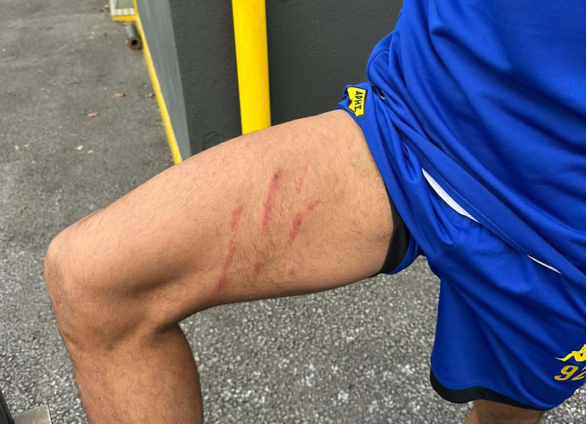 Άρης: Τα σημάδια που άφησε στο πόδι του Ρόουζ το μαρκάρισμα του Ιβανούσετς