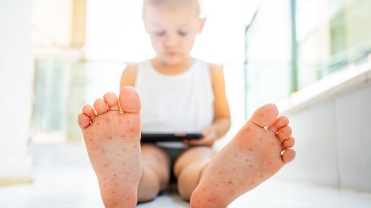 Enterovirus Leg - arm - mouth. Rash on the body of a child. Cocksackie virus. High quality photo