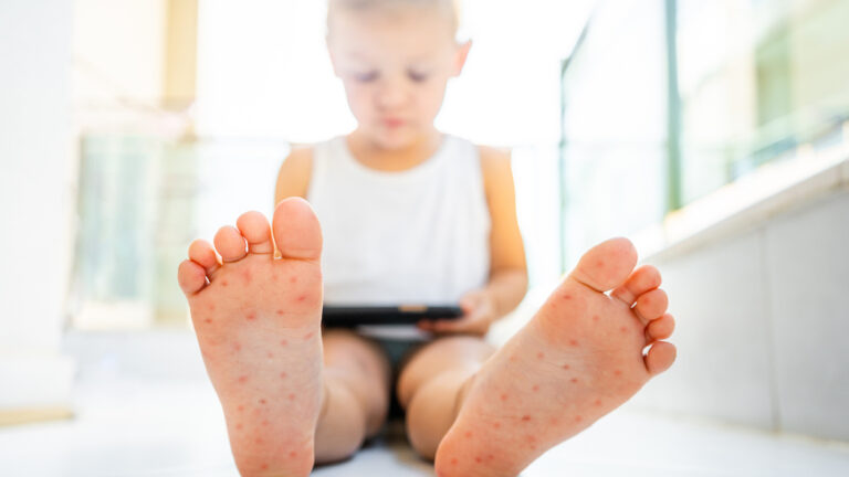 Enterovirus Leg - arm - mouth. Rash on the body of a child. Cocksackie virus. High quality photo