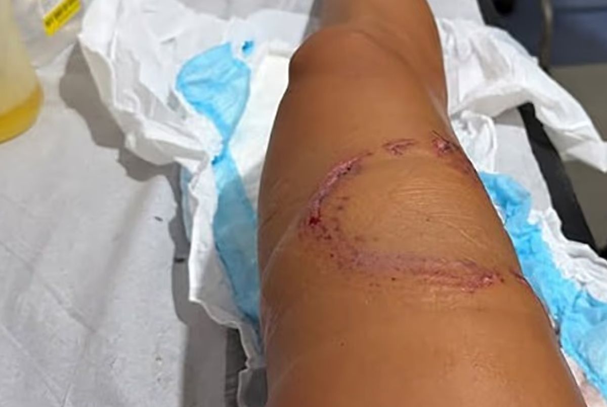 Ο καρχαρίας την δάγκωσε στο πόδι