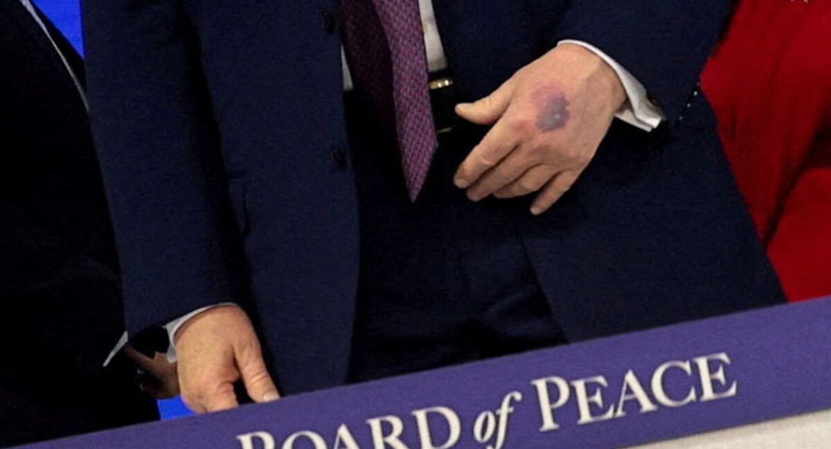 H μελανιά στο χέρι του Τραμπ