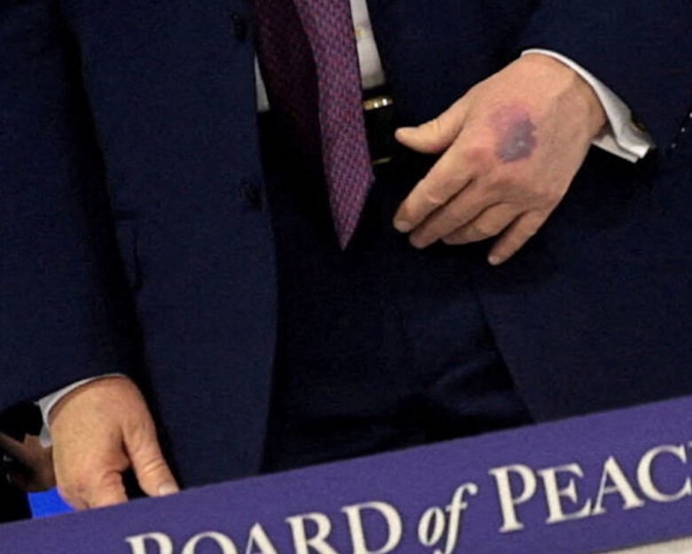 H μελανιά στο χέρι του Τραμπ