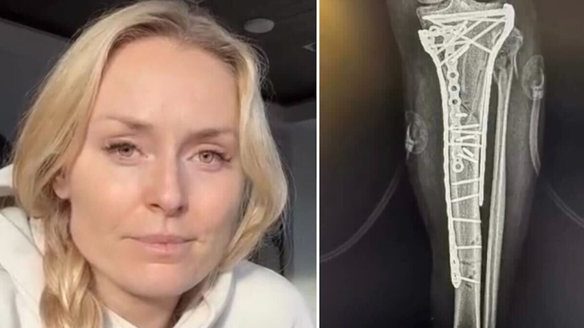 Συγκλονίζει η Λίντσεϊ Βον: «Το χειρουργείο μετά το ατύχημα με έσωσε από τον ακρωτηριασμό»
