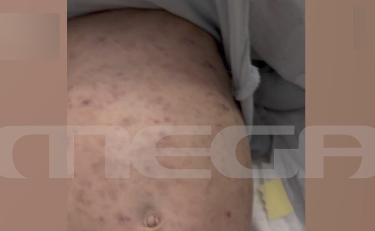 Το βρέφος με μηνιγγίτιδα