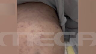 Το βρέφος με μηνιγγίτιδα