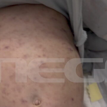 Το βρέφος με μηνιγγίτιδα