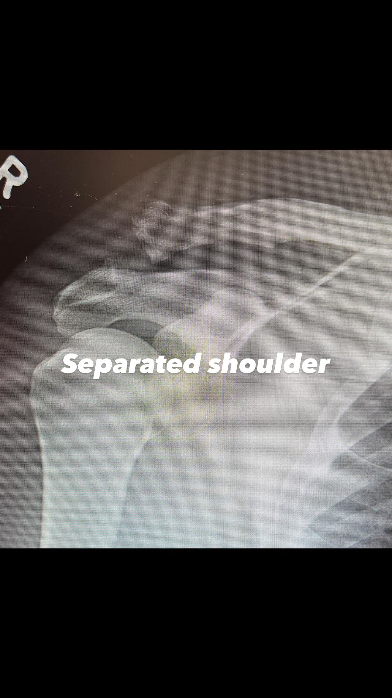 Η φωτογραφία με τον σπασμένο ώμο