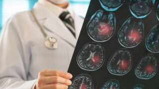 Doctor radiology looking stroke brain x-ray image for diagnose ischemic stroke or cerebrovascular disease at hospital.