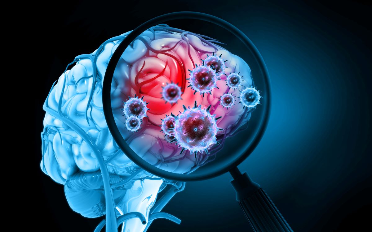 Μηνιγγίτιδα