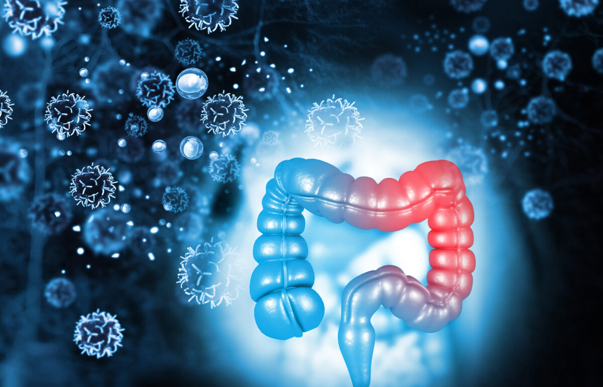 Καρκίνος παχέος εντέρου