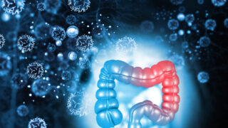 Καρκίνος παχέος εντέρου