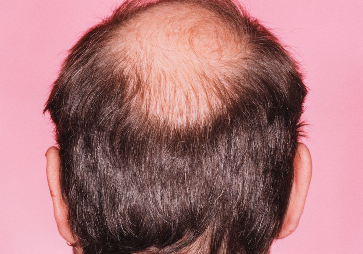 Τριχόπτωση: Πειραματικός φυτικός ορός «δείχνει» αποτελέσματα σε πρώιμη μελέτη