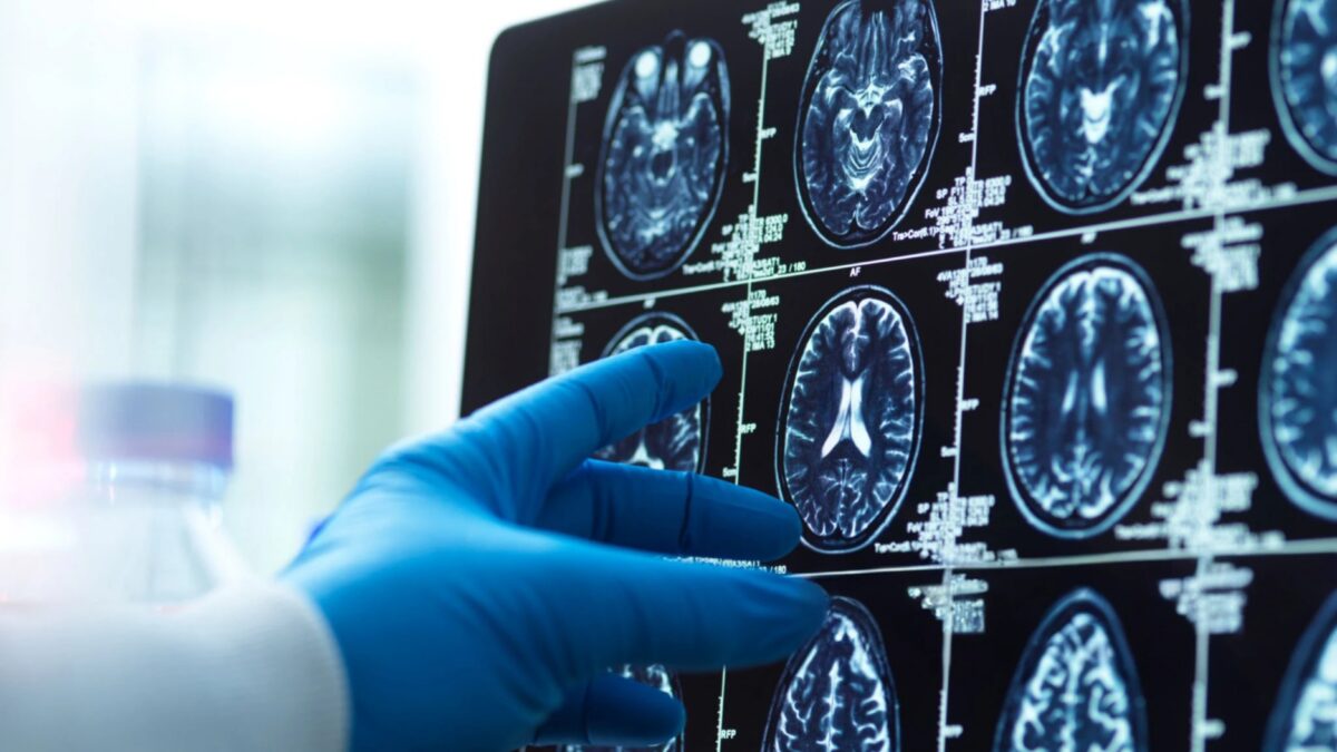 A doctor's hand in a surgical glove pointing at a brain scan image on a computer screen, diagnostic tools and medical concepts.