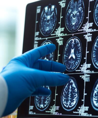 A doctor's hand in a surgical glove pointing at a brain scan image on a computer screen, diagnostic tools and medical concepts.