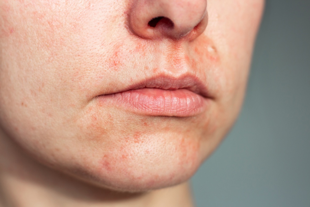 Περιστοματική ακμή: Γιατί εμφανίζεται και πώς να την αντιμετωπίσετε αποτελεσματικά