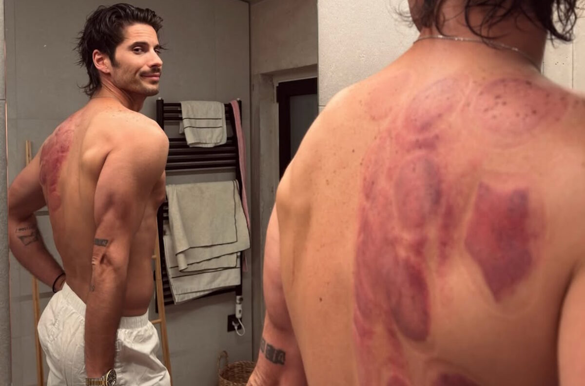 Ο Γιώργος Καράβας αποκάλυψε το πρόβλημα που έχει στην ωμοπλάτη - Κάνει βεντούζες για να θεραπευτεί