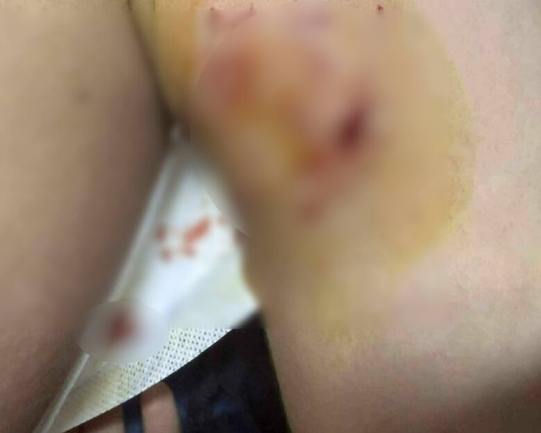 τραυμα 12χρονου