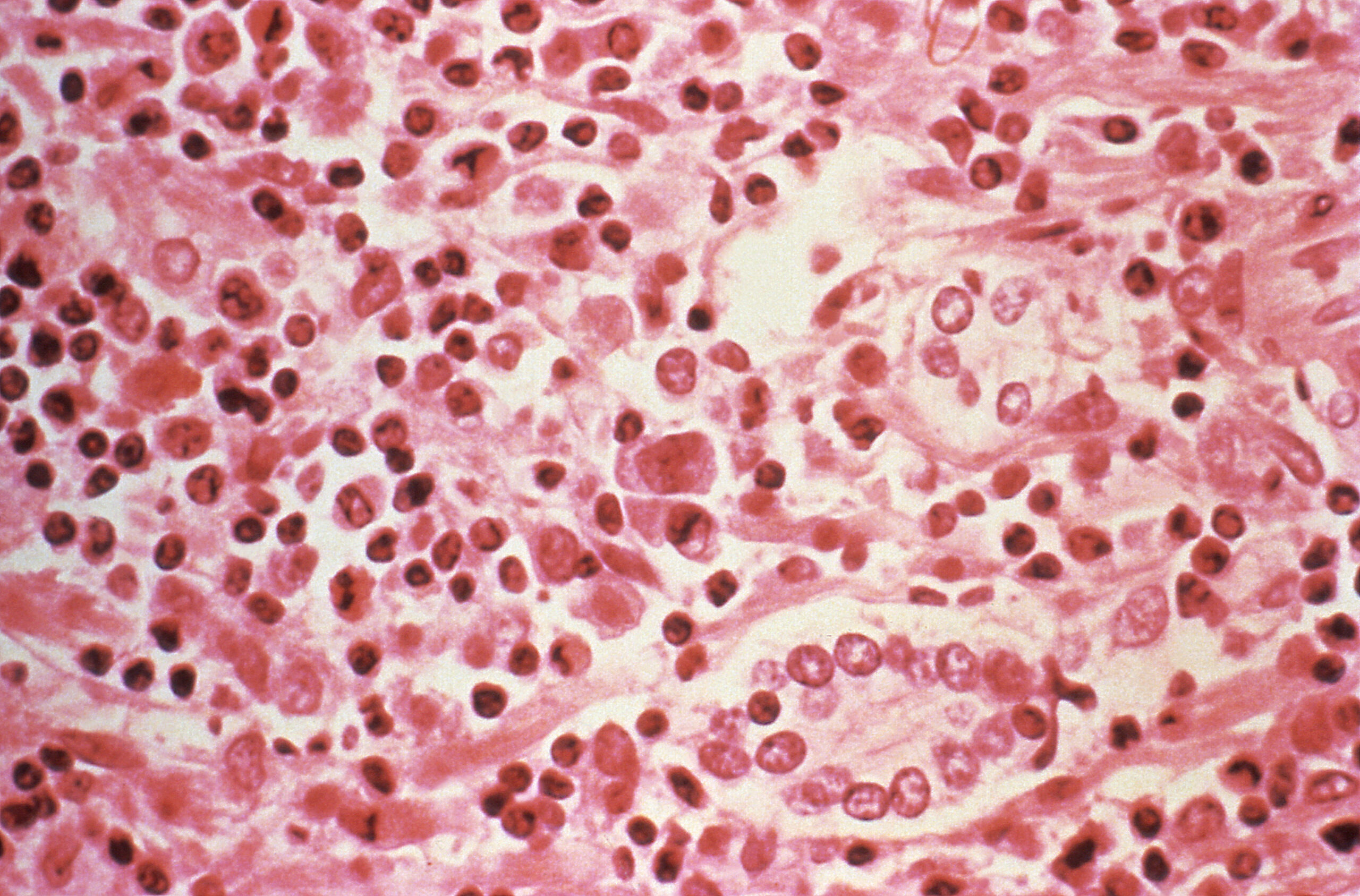 FILE PHOTO: A micrographic study of liver tissue seen from a Hantavirus pulmonary syndrome (HPS) patient seen in this undated photo obtained by Reuters, July 6, 2017. Centers for Disease Control and Prevention/Handout via REUTERS ATTENTION EDITORS - THIS IMAGE WAS PROVIDED BY A THIRD PARTY./File Photo