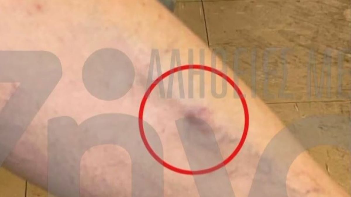Ασθενής χτυπήθηκε από συνοδούς άλλου ασθενούς μέσα σε νοσοκομείο