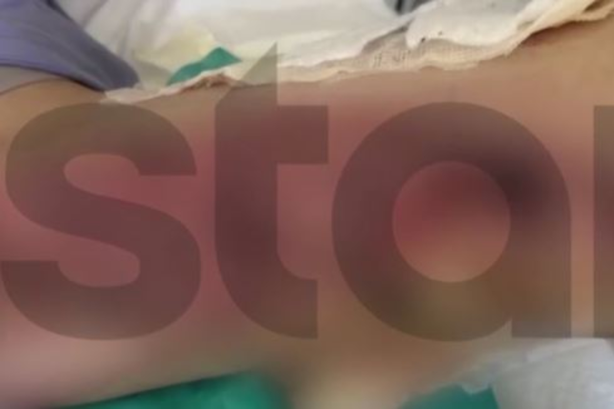 Θεσσαλονίκη: Έκανε επέμβαση ρουτίνας και βγήκε με εγκαύματα γ' βαθμού - «Είχα γαντζωθεί στο κρεβάτι, έβραζαν τα πόδια μου», καταγγέλλει 20χρονη