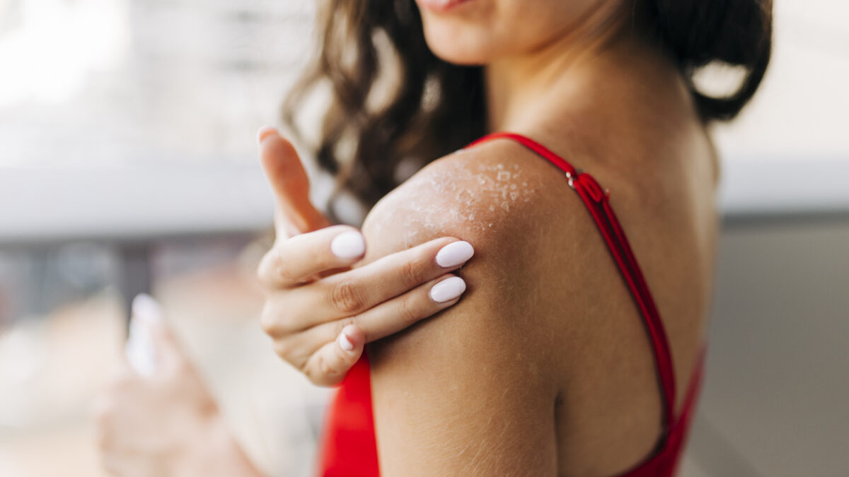 Close up of woman applying moisturizer on sunburned skin