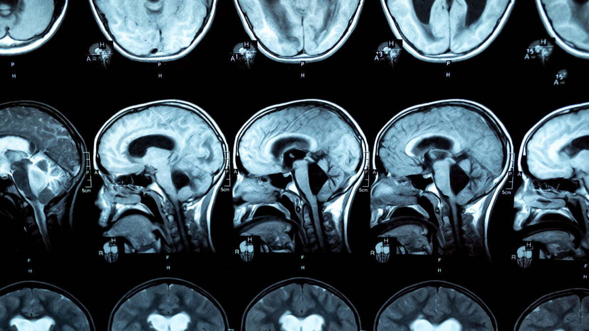 MRI scan or magnetic resonance image of the brain showed obstructive triventricular hydrocephalus with clinical of hydrocephalus: cognitive decline, incontinence. Neurology, medical service concept.