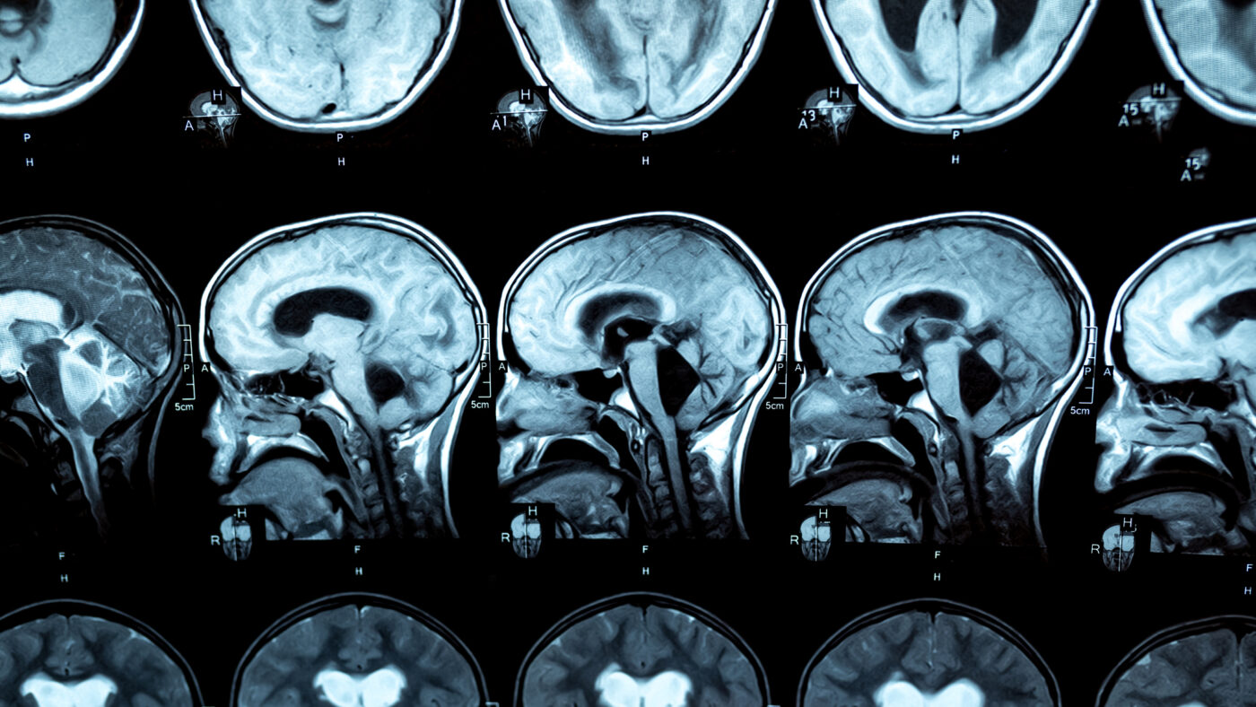 MRI scan or magnetic resonance image of the brain showed obstructive triventricular hydrocephalus with clinical of hydrocephalus: cognitive decline, incontinence. Neurology, medical service concept.
