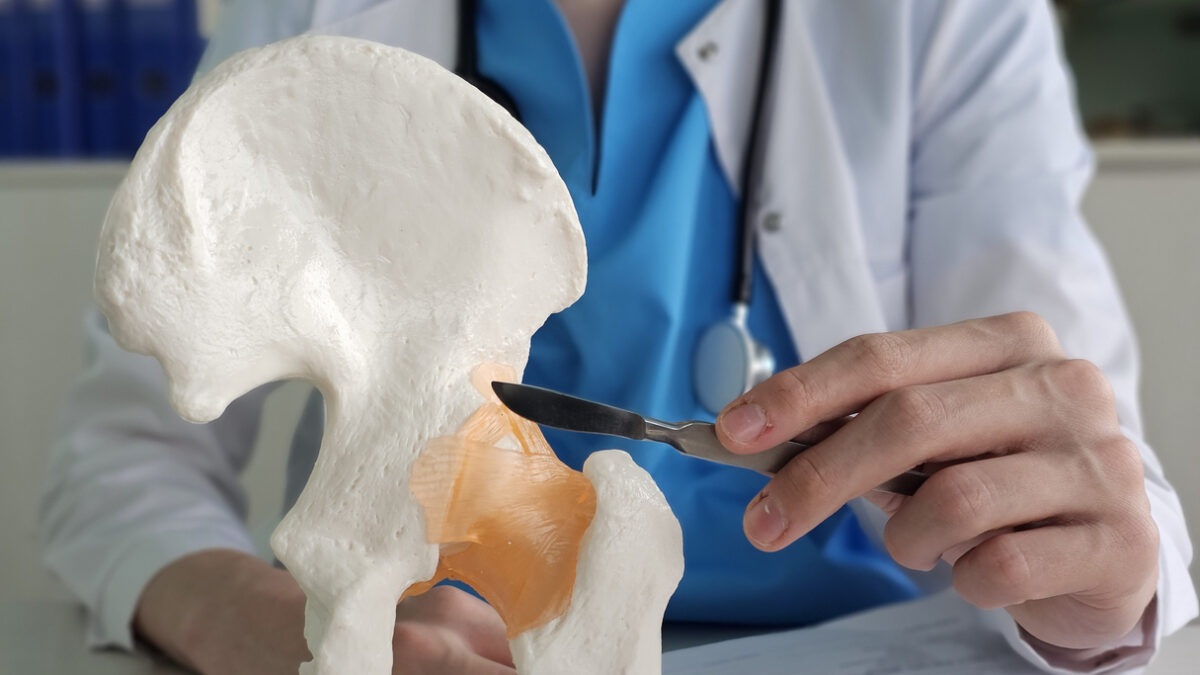 Hip replacement surgery. A doctor holds a scalpel. Hip arthroplasty concept