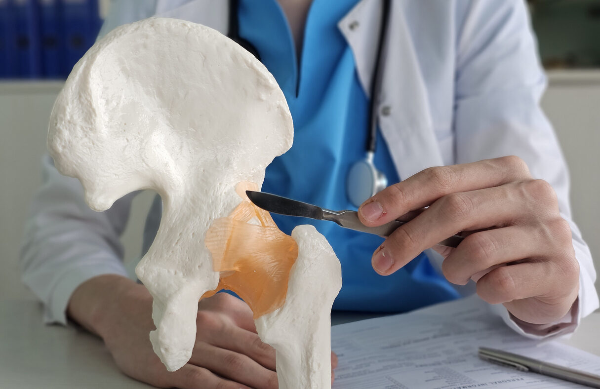 Hip replacement surgery. A doctor holds a scalpel. Hip arthroplasty concept